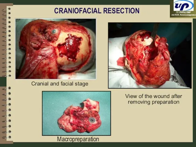 CRANIOFACIAL RESECTION Cranial and facial stage View of the wound after removing preparation Macropreparation