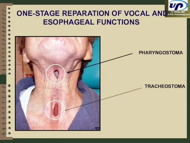 ONE-STAGE REPARATION OF VOCAL AND ESOPHAGEAL FUNCTIONS PHARYNGOSTOMA TRACHEOSTOMA