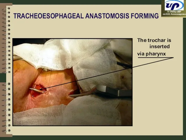 TRACHEOESOPHAGEAL ANASTOMOSIS FORMING The trochar is inserted via pharynx