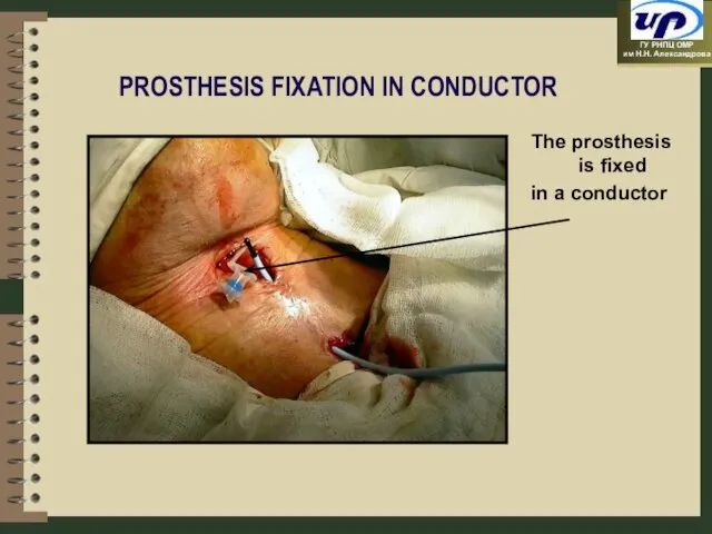 PROSTHESIS FIXATION IN CONDUCTOR The prosthesis is fixed in a conductor