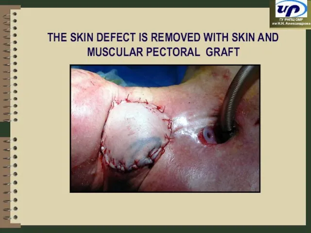 THE SKIN DEFECT IS REMOVED WITH SKIN AND MUSCULAR PECTORAL GRAFT