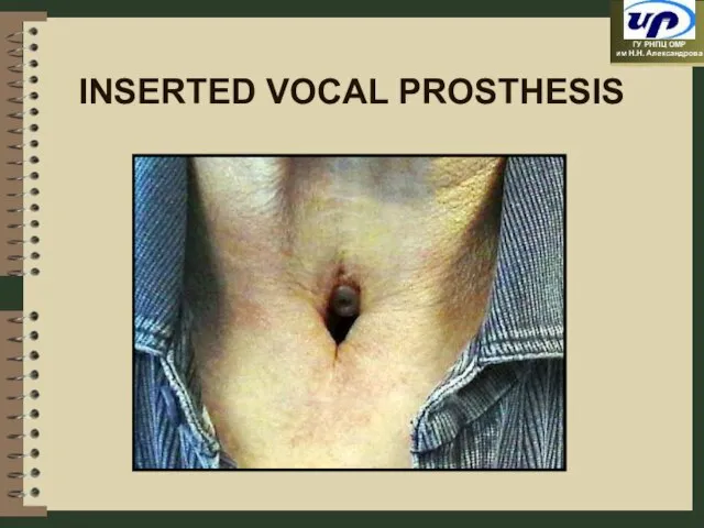 INSERTED VOCAL PROSTHESIS