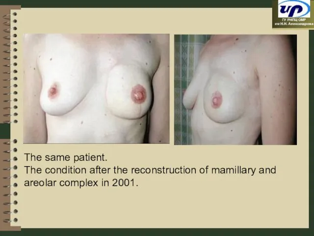 The same patient. The condition after the reconstruction of mamillary and areolar complex in 2001.