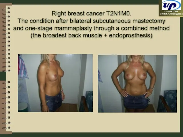 Right breast cancer Т2N1М0. The condition after bilateral subcutaneous mastectomy and one-stage
