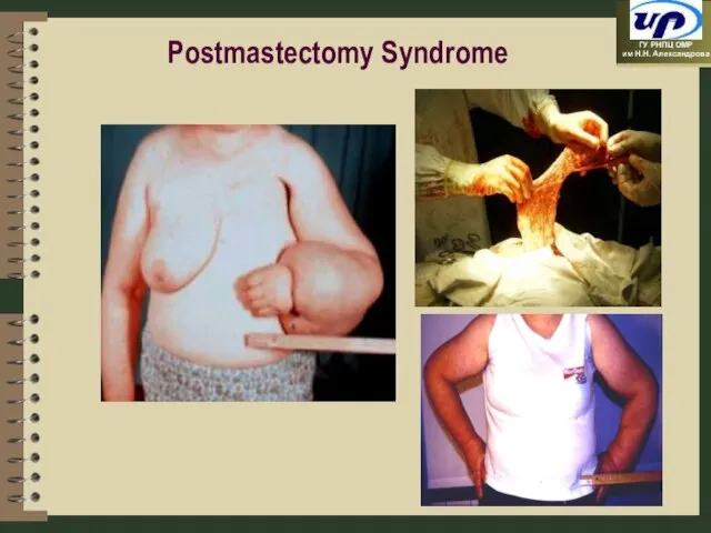 Postmastectomy Syndrome