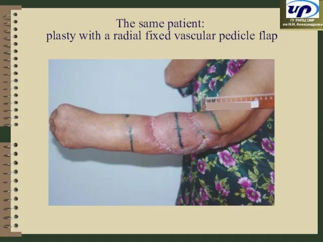 The same patient: plasty with a radial fixed vascular pedicle flap