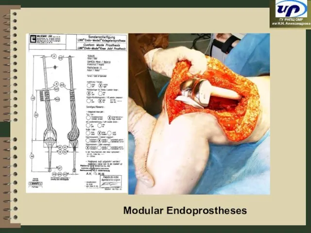 Modular Endoprostheses