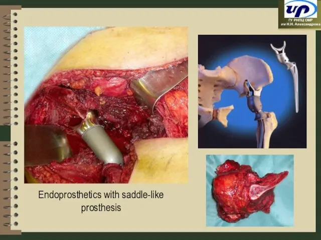 Endoprosthetics with saddle-like prosthesis