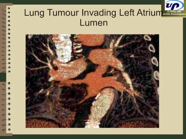 Lung Tumour Invading Left Atrium Lumen