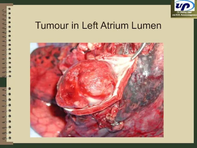 Tumour in Left Atrium Lumen