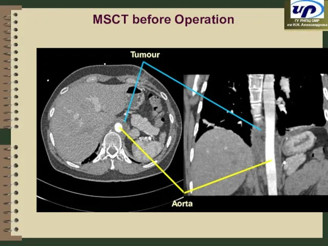 MSCT before Operation