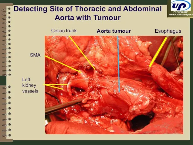 Detecting Site of Thoracic and Abdominal Aorta with Tumour Esophagus Celiac trunk