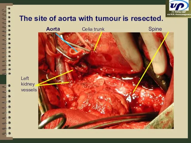 Spine Left kidney vessels Aorta The site of aorta with tumour is resected. Celia trunk