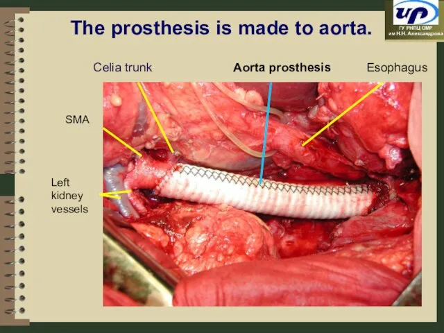 Esophagus Left kidney vessels Aorta prosthesis The prosthesis is made to aorta. Celia trunk SMА