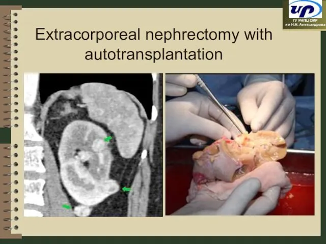 Extracorporeal nephrectomy with autotransplantation