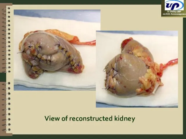 View of reconstructed kidney