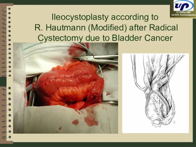Ileocystoplasty according to R. Hautmann (Modified) after Radical Cystectomy due to Bladder Cancer