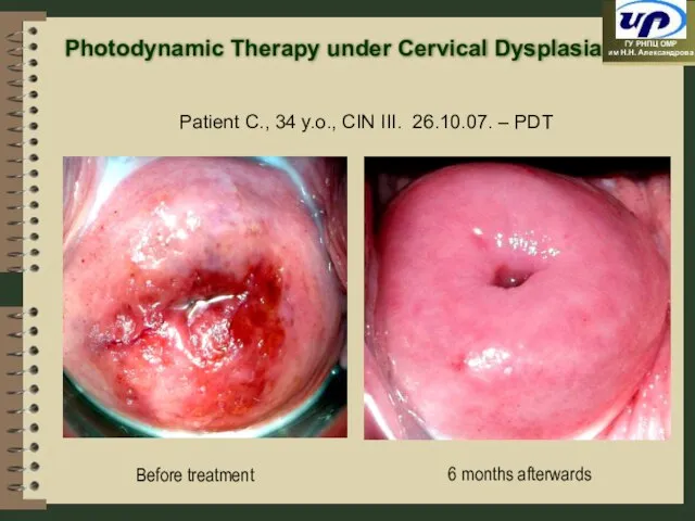 6 months afterwards Patient C., 34 y.o., CIN III. 26.10.07. – PDT