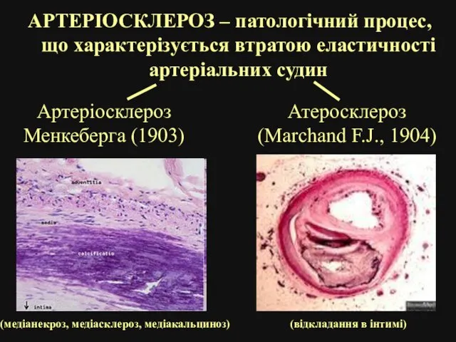 АРТЕРІОСКЛЕРОЗ – патологічний процес, що характерізується втратою еластичності артеріальних судин Атеросклероз (Marchand