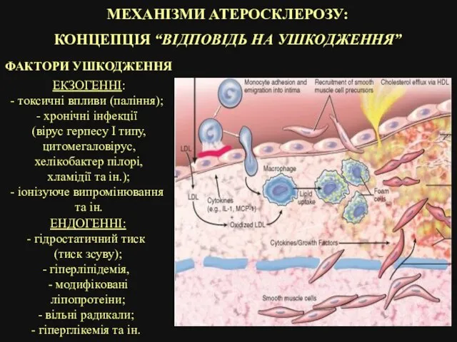 МЕХАНІЗМИ АТЕРОСКЛЕРОЗУ: КОНЦЕПЦІЯ “ВІДПОВІДЬ НА УШКОДЖЕННЯ” ФАКТОРИ УШКОДЖЕННЯ ЕКЗОГЕННІ: токсичні впливи (паління);