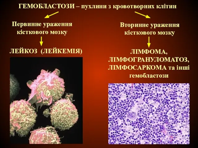 ГЕМОБЛАСТОЗИ – пухлини з кровотворних клітин Первинне ураження кісткового мозку ЛЕЙКОЗ (ЛЕЙКЕМІЯ)