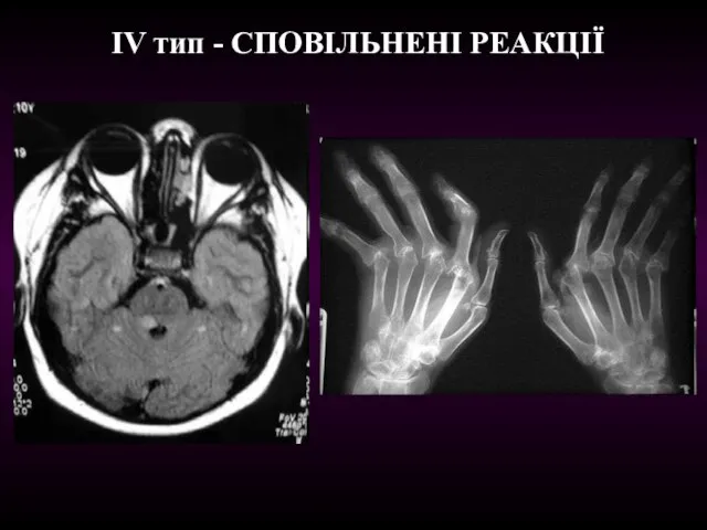 ІV тип - CПОВІЛЬНЕНІ РЕАКЦІЇ