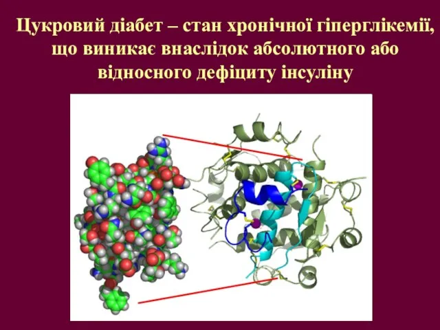 Цукровий діабет – стан хронічної гіперглікемії, що виникає внаслідок абсолютного або відносного дефіциту інсуліну