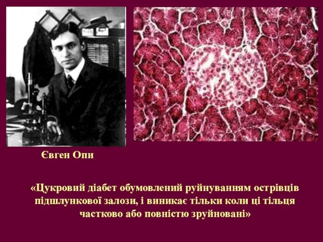 Євген Опи «Цукровий діабет обумовлений руйнуванням острівців підшлункової залози, і виникає тільки