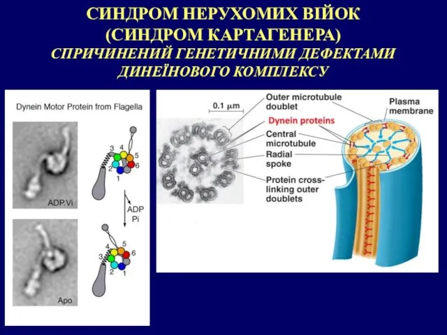 СИНДРОМ НЕРУХОМИХ ВІЙОК (СИНДРОМ КАРТАГЕНЕРА) СПРИЧИНЕНИЙ ГЕНЕТИЧНИМИ ДЕФЕКТАМИ ДИНЕЇНОВОГО КОМПЛЕКСУ