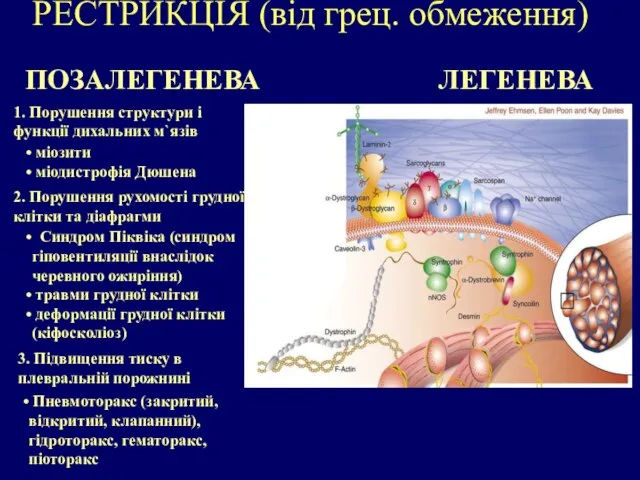 РЕСТРИКЦІЯ (від грец. обмеження) ПОЗАЛЕГЕНЕВА Пневмоторакс (закритий, відкритий, клапанний), гідроторакс, гематоракс, піоторакс