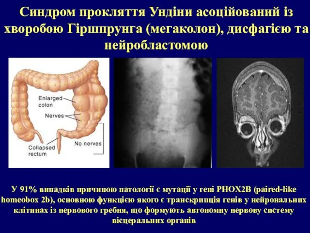 Синдром прокляття Ундіни асоційований із хворобою Гіршпрунга (мегаколон), дисфагією та нейробластомою У