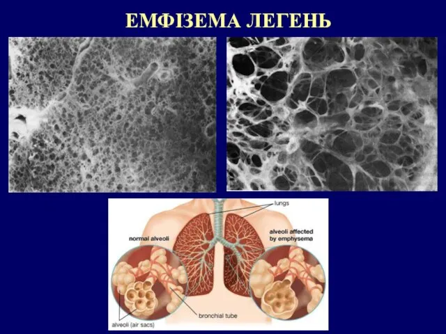 ЕМФІЗЕМА ЛЕГЕНЬ