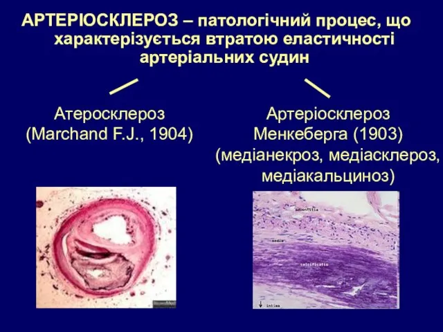 АРТЕРІОСКЛЕРОЗ – патологічний процес, що характерізується втратою еластичності артеріальних судин Атеросклероз (Marchand