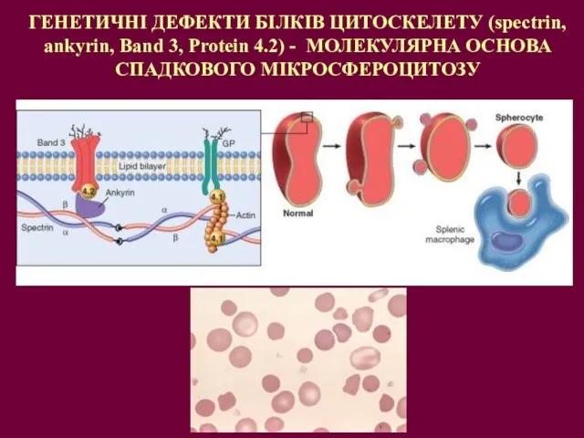 ГЕНЕТИЧНІ ДЕФЕКТИ БІЛКІВ ЦИТОСКЕЛЕТУ (spectrin, ankyrin, Band 3, Protein 4.2) - МОЛЕКУЛЯРНА ОСНОВА СПАДКОВОГО МІКРОСФЕРОЦИТОЗУ