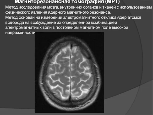 Магниторезонансная томография (МРТ) Метод исследования мозга, внутренних органов и тканей с использованием