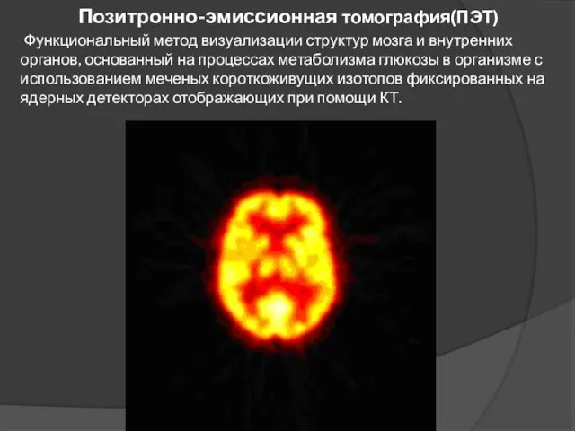 Позитронно-эмиссионная томография(ПЭТ) Функциональный метод визуализации структур мозга и внутренних органов, основанный на