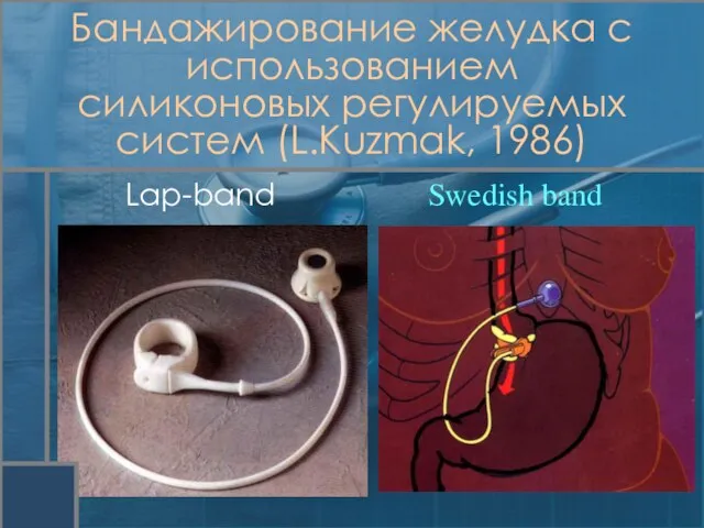 Lap-band Swedish band Бандажирование желудка с использованием силиконовых регулируемых систем (L.Kuzmak, 1986)