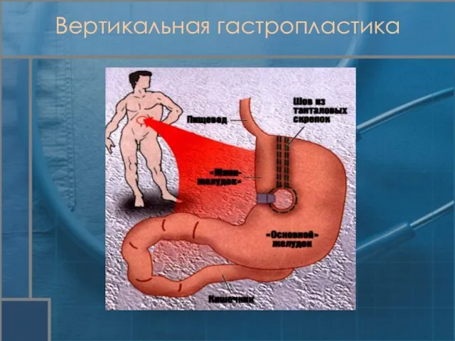 Вертикальная гастропластика