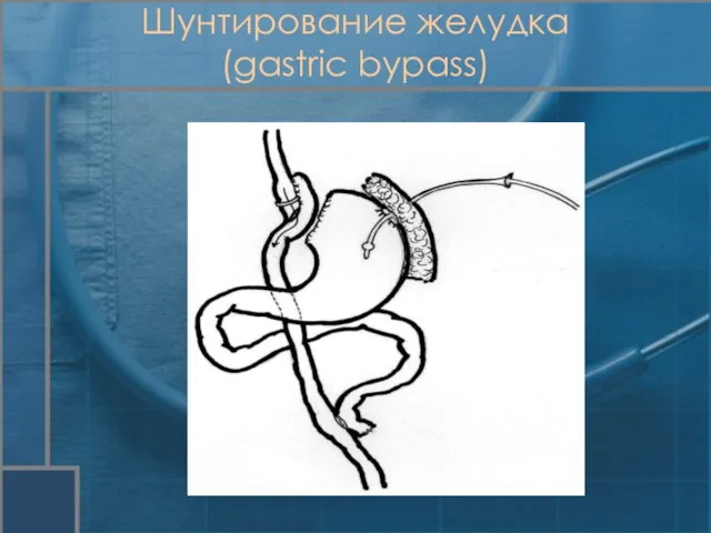 Шунтирование желудка (gastric bypass)