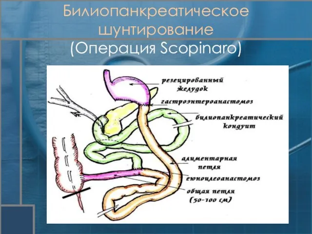 Билиопанкреатическое шунтирование (Операция Scopinaro)