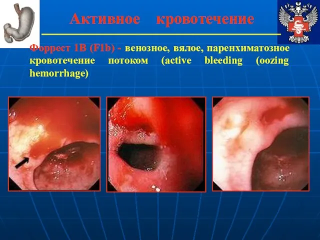 Активное кровотечение Форрест 1В (F1b) - венозное, вялое, паренхиматозное кровотечение потоком (active bleeding (oozing hemorrhage)