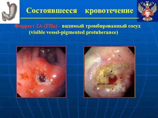 Состоявшееся кровотечение Форрест 2А (FIIa) - видимый тромбированный сосуд (visible vessel-pigmented protuberance)