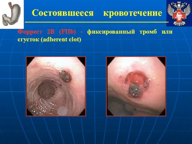 Состоявшееся кровотечение Форрест 2В (FIIb) - фиксированный тромб или сгусток (adherent clot)