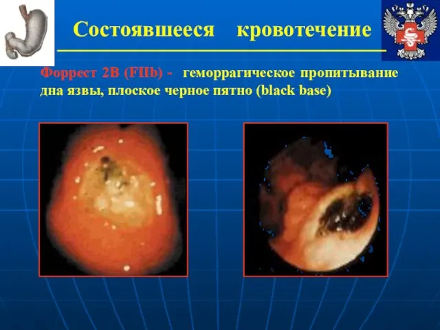 Состоявшееся кровотечение Форрест 2В (FIIb) - геморрагическое пропитывание дна язвы, плоское черное пятно (black base)