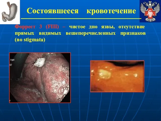 Состоявшееся кровотечение Форрест 3 (FIII) – чистое дно язвы, отсутствие прямых видимых вешеперечисленных признаков (no stigmata)