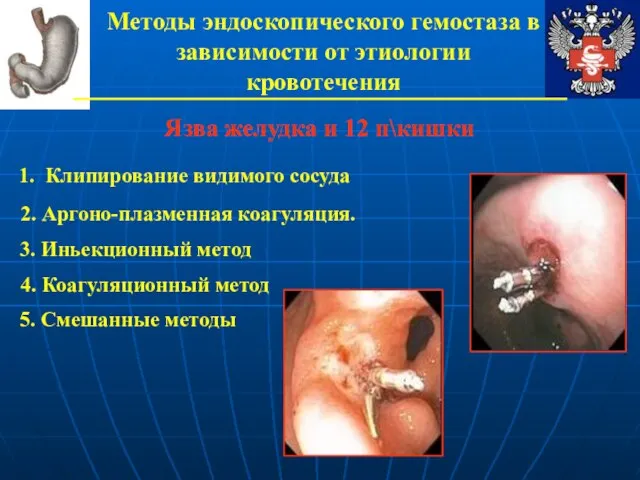 Методы эндоскопического гемостаза в зависимости от этиологии кровотечения Язва желудка и 12