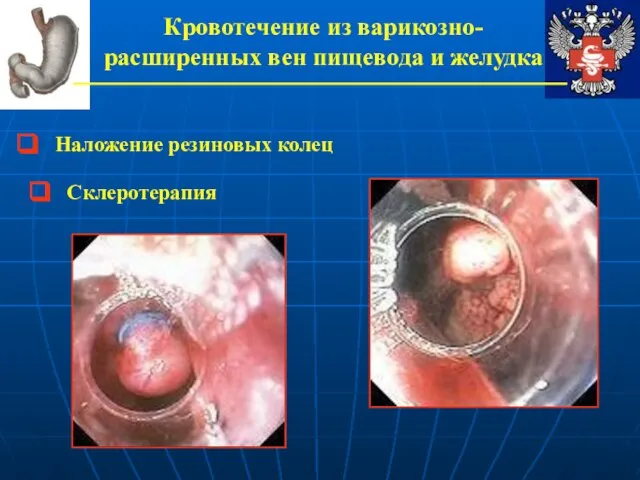 Кровотечение из варикозно-расширенных вен пищевода и желудка Наложение резиновых колец Склеротерапия