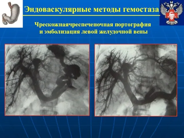 Эндоваскулярные методы гемостаза Чрескожнаячреспеченочная портография и эмболизация левой желудочной вены