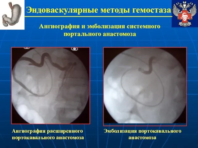 Эндоваскулярные методы гемостаза Ангиография и эмболизация системного портального анастомоза Ангиография расширенного портокавального анастомоза Эмболизация портокавального анастомоза