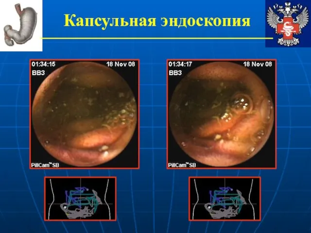 Капсульная эндоскопия